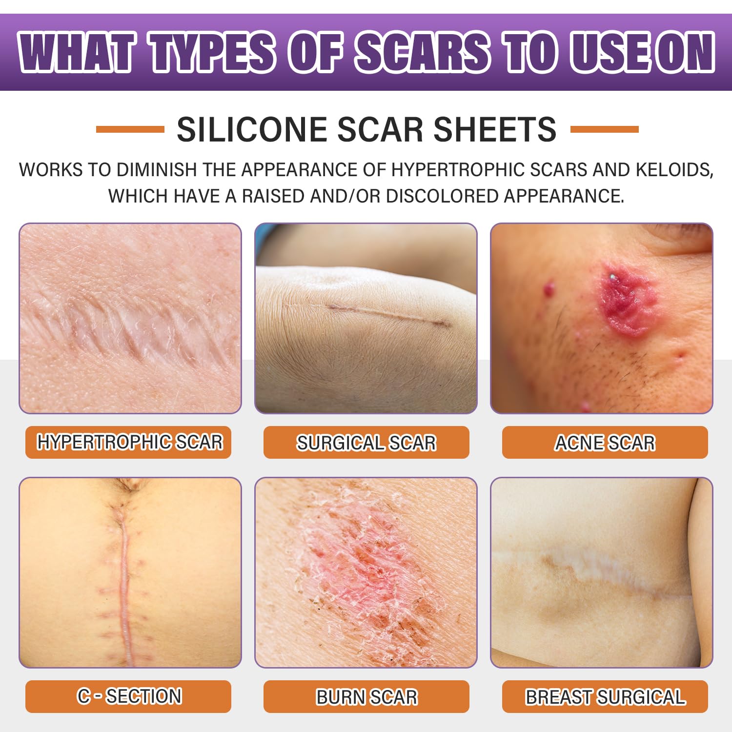 Silicone Scar Sheets,Silicone Scar Tape,Silicone Scar Removal Strips for Surgical,C-Section,Tummy Tuck,Keloid Scars (1.6"X 59" Roll-1.5M) Keloid Bump Removal